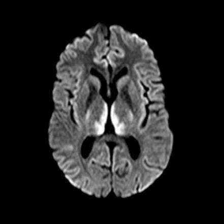 Wernicke Encephalopathy MRI