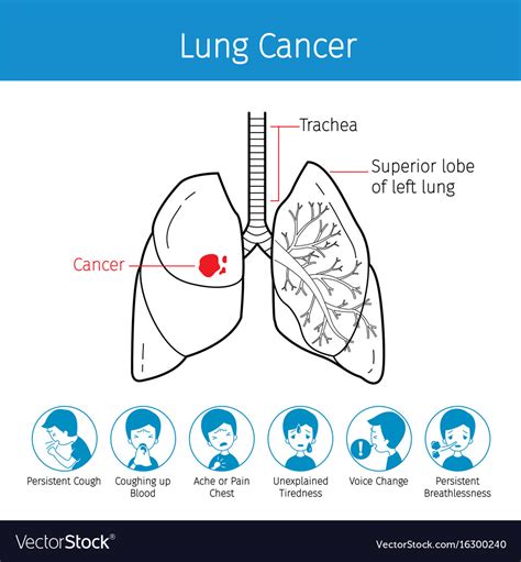 Nursing Pathophysiology Of Lung Cancer Diagram