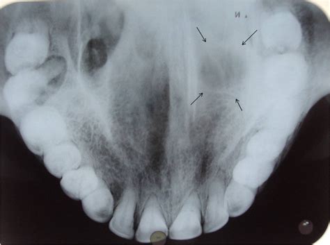 Occlusal Radiograph Showing Uniform Circular Radiolucent Lesion