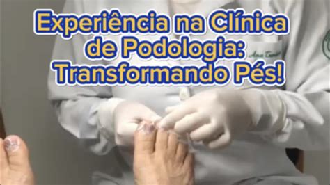 TRATAMENTO CALOS E CALOSIDADES YouTube