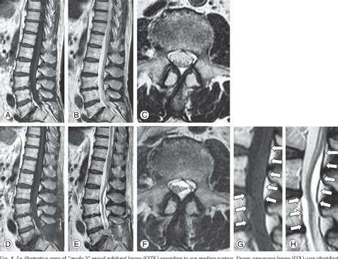 Figure 4 From Postoperative Spinal Subdural Lesions Following Lumbar