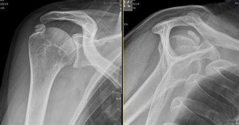 Sports Injury Bulletin Anatomy Calcific Tendonitis Of The Shoulder