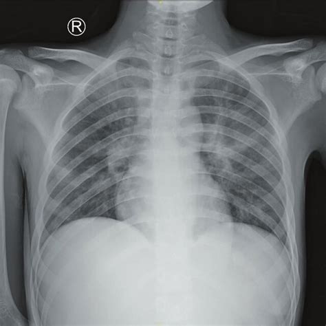 The Chest X Ray Examination Revealed Bilateral Pneumonia Download