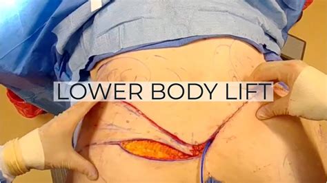 Lower Body Lift Dr Repta Plastic Surgery Youtube