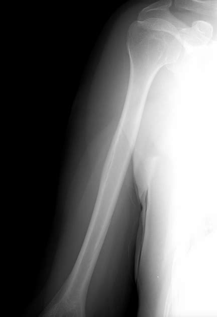 Deltoid Tuberosity X Ray