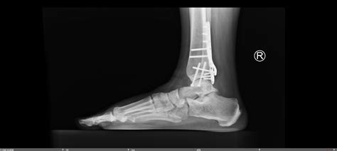 Trimalleolar Ankle Fracture Chicago Foot Ankle Orthopaedic Surgeons