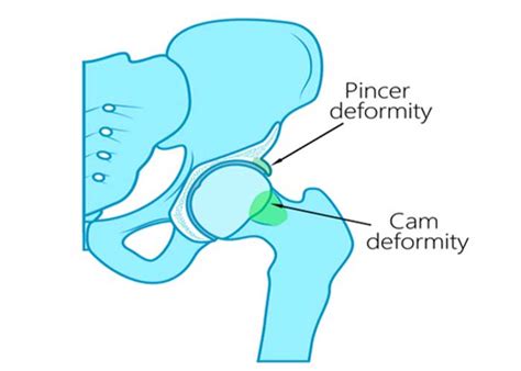 Femoroplasty | Hip Surgeon | Los Angeles, Orange County, CA