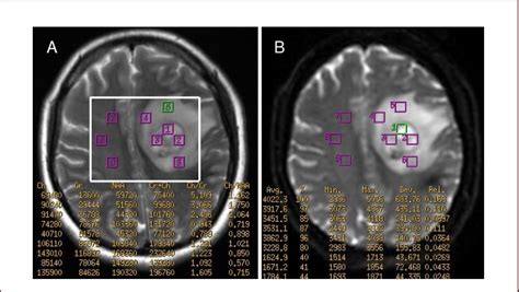 Measurement Of Magnetic Resonance Spectroscopy MRS And Diffusion