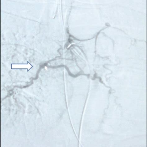 A Selective Right Bronchial Artery Angiography Showed Collateral Flow