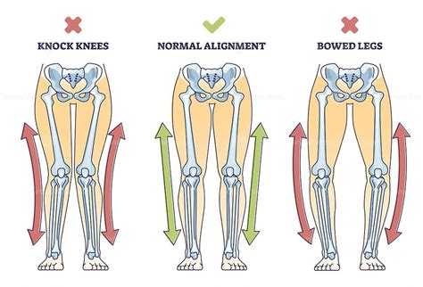 Bowed Legs Syndrome With Normal And Knock Legs Comparison Outline