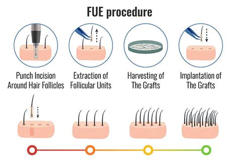 Follicular Unit Extraction Fue Best Hair Transplants