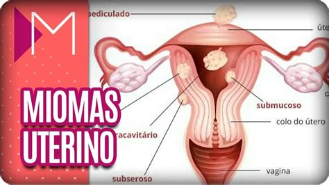 Miomas Uterino Mulheres Youtube