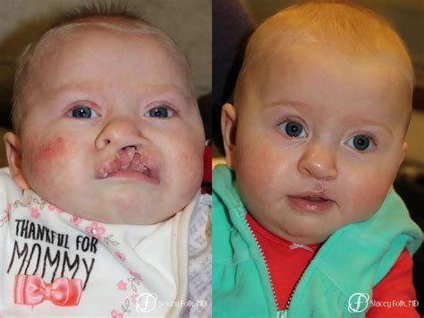 Cleft Palate Repair Before And After