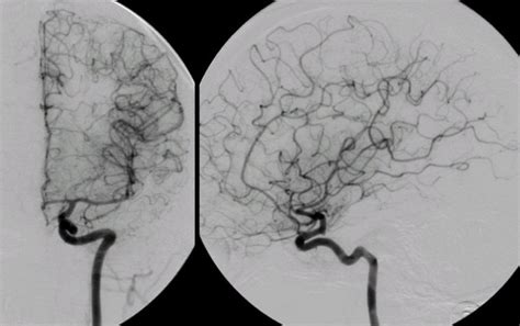 Internal Carotid