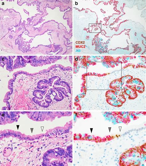 Intestinal Features Emerged Gradually In Gastric Type Ipmns He