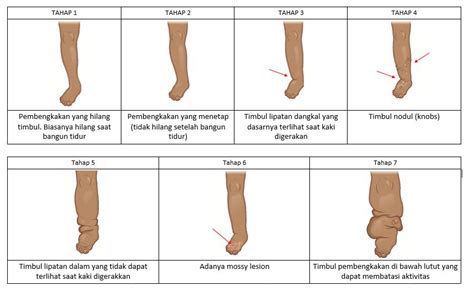 Mengenal Filariasis Atau Kaki Gajah Belajar Epidemiologi