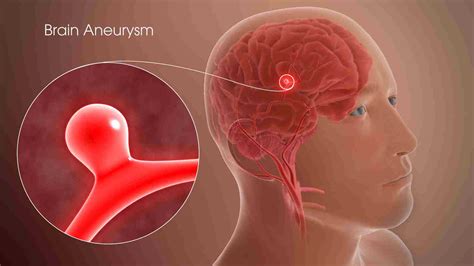 Brain Aneurysms Symptoms Types And Treatment Options