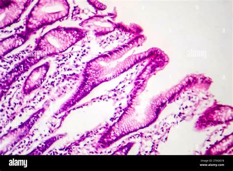 Photomicrograph Of Intestinal Metaplasia Displaying Transformation Of