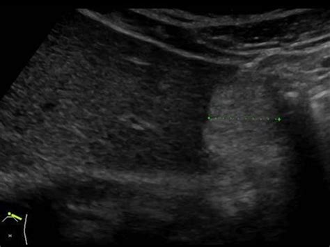 Abdomen And Retroperitoneum 1 1 Liver Case 1 1 2 Hemangiomas