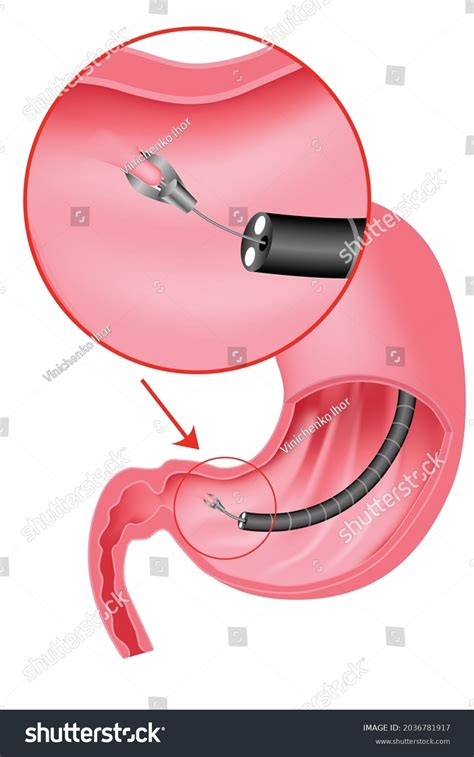 213 Biopsy forceps 图片库存照片和矢量图 Shutterstock