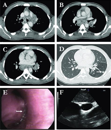 Computed Tomography Scan Showing Necrotic Mediastinal And Hilar Lymph