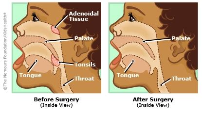 Adenoid Face Before And After