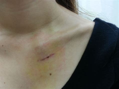 Broken Collarbone Surgery Singapore | Clavicle Fixation