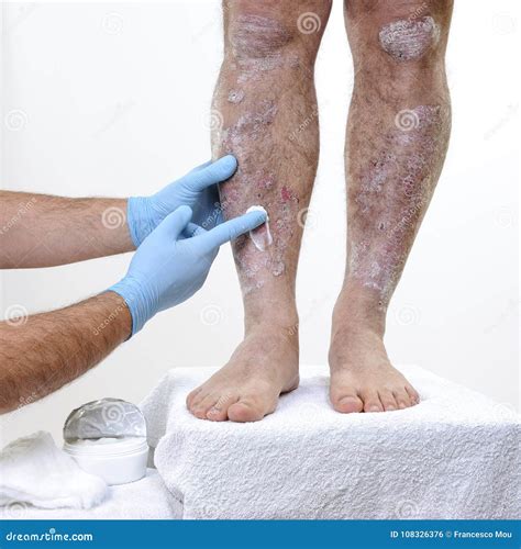 The Dermatologist Cure An Adult Man Suffering From Psoriasis On Legs