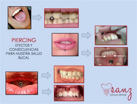 Riesgos Del Piercing Labial En Salud Oral Blog Dental Irriak