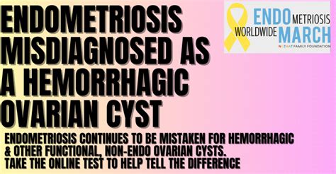 Endometrioma Chocolate Cyst Vs Hemmorhagic Ovarian Cyst Which Is It Or