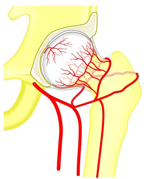 Avascular Necrosis Causes Symptoms And Treatment Apollo Hospital