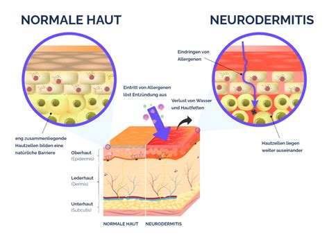 Neurodermitis Entz Ndung Ursachen Nia