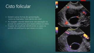 O Que E Cisto Folicular - Cisto ovariano funcional | PPTX