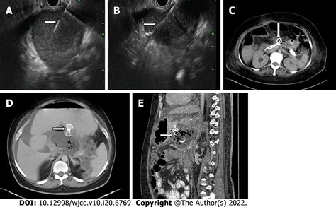 Drainage Of Pancreatic Fluid Collections In Acute Pancreatitis A