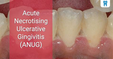 Acute Necrotising Ulcerative Gingivitis Anug Dentalnotebook