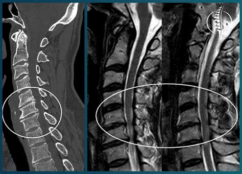 H Rnia De Disco Cervical Dr Pedro Paschoal