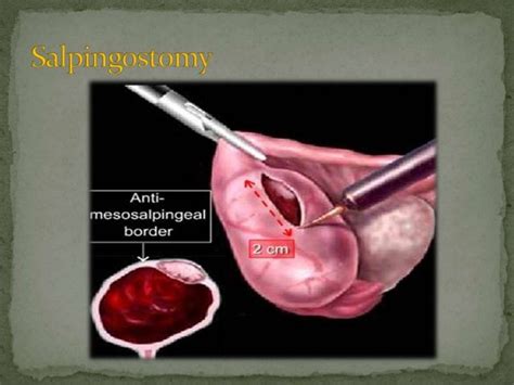 Ectopic Pregnancy