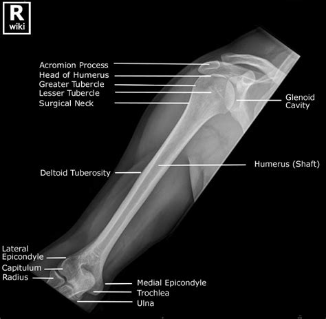 Radiographic Anatomy Of The Humerus Radiologypicscom