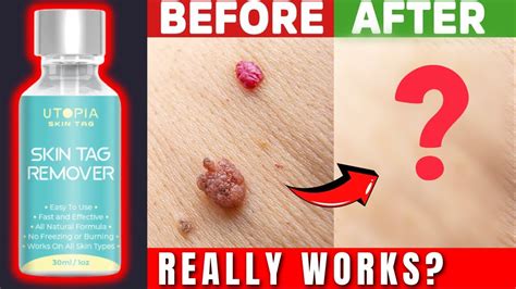 Utopia Skin Tag Remover Does It Work Discover The Effectiveness Of