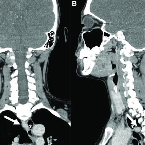 A Coronal And B Sagittal Contrast Enhanced Computed Tomography