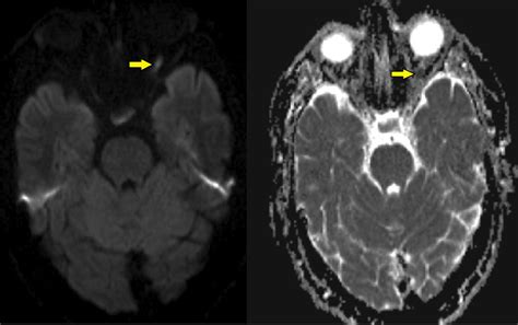 Acute Optic Neuritis With Diffusion Restriction On Mri Bmj Case Reports