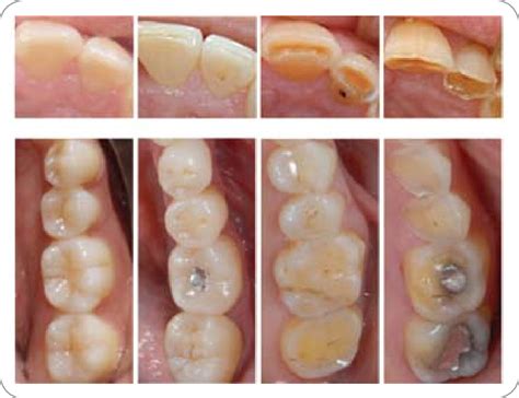 The Stages Of Enamel Erosion Understanding The Progression Of Tooth Damage