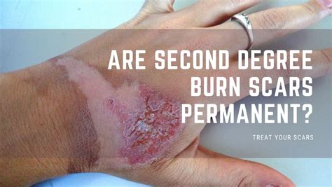 Are Second Degree Burn Scars Permanent - Treat Your Scars