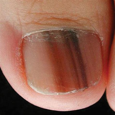 Albums 103 Pictures Photos Of Toe Nail Melanoma Updated