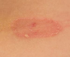 Micose X Psoríase - Dermatologia e Saúde