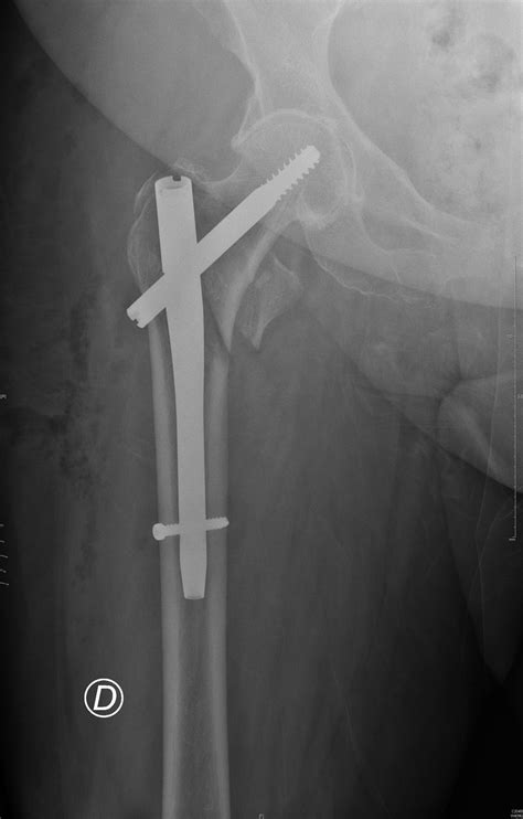 Fracture Du Massif Trochanterien Ortho7