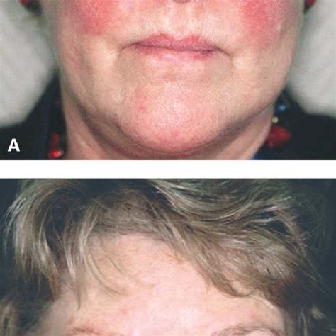 A 56 Year Old Woman With Facial Erythema Telangiectasia Flushing Download Scientific Diagram