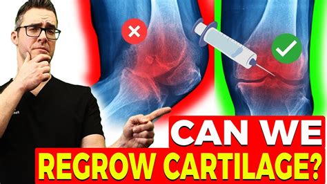 Revolutionizing Cartilage Regeneration New Insights And Treatments