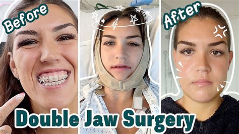 6 DAYS AFTER DOUBLE JAW SURGERY! (Jaw Surgery Recovery Vlog) Ep. 4 in ...