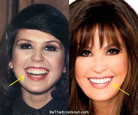 Marie Osmond Plastic Surgery Comparison Photos